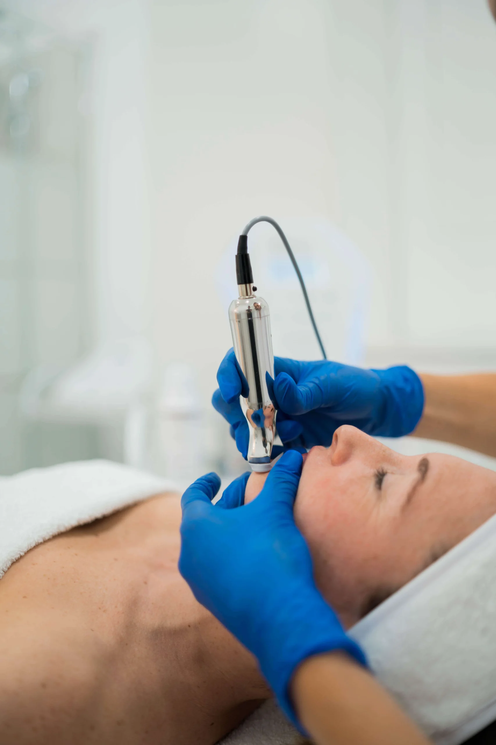benefiucios del microneedling facial en palma de mallorca